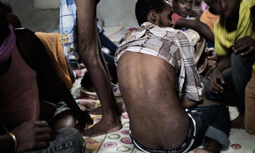 Un Erythréen montre son dos avec une maladie de peau contractée dans une cellule dans un centre de détention près de Tripoli, en Libye. Photo UNICEF/Alessio Romenzi