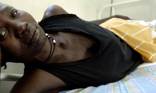 Une patiente souffrant d’une fistule obstétricale, l’une des lésions les plus graves et dangereuses susceptibles de survenir lors d’un accouchement. Photo ONU/Tim McKulka